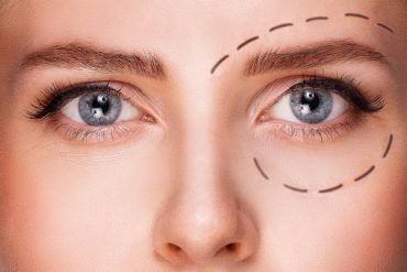 3-Retises CT Yellow Peel